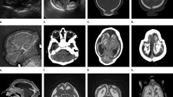 MRI images obtained in the case of an 18-year-old woman with confirmed Zika virus infection in Brazil
