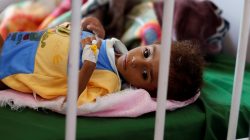 A malnourished boy lies on a bed at a malnutrition treatment center in Sanaa, Yemen October 7, 2018. REUTERS/Khaled Abdullah